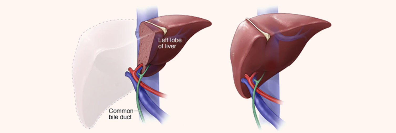 Types-of-Liver-Transplant