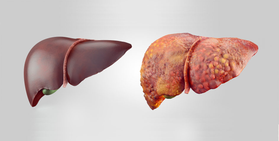 fatty-liver-treatment-in-indore-india