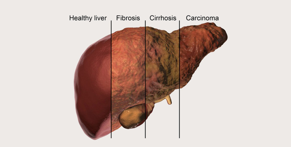 liver-cirrhosis-treatment-in-indore-india